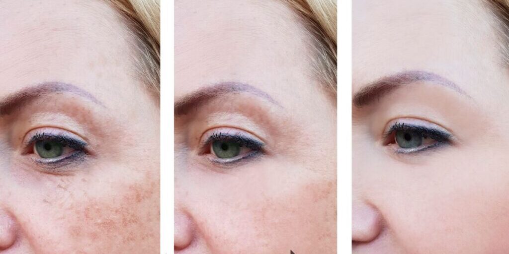 The Effects of Botox on Fine Lines and Wrinkles The Effects of Botox on Fine Lines and Wrinkles