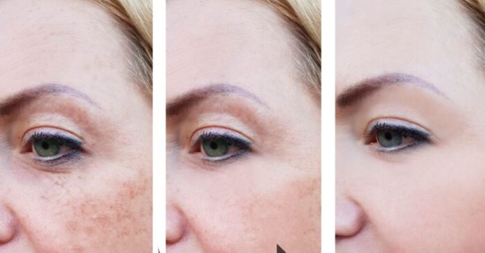 The Effects of Botox on Fine Lines and Wrinkles