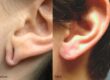 What To Know About Earlobe Repair Procedures
