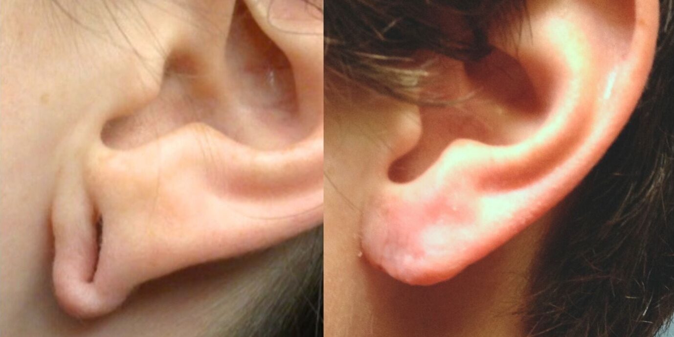 What To Know About Earlobe Repair Procedures What To Know About Earlobe Repair Procedures