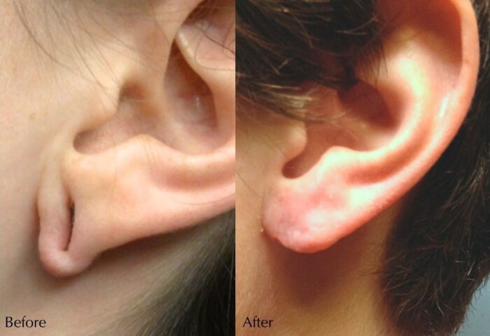 What To Know About Earlobe Repair Procedures What To Know About Earlobe Repair Procedures