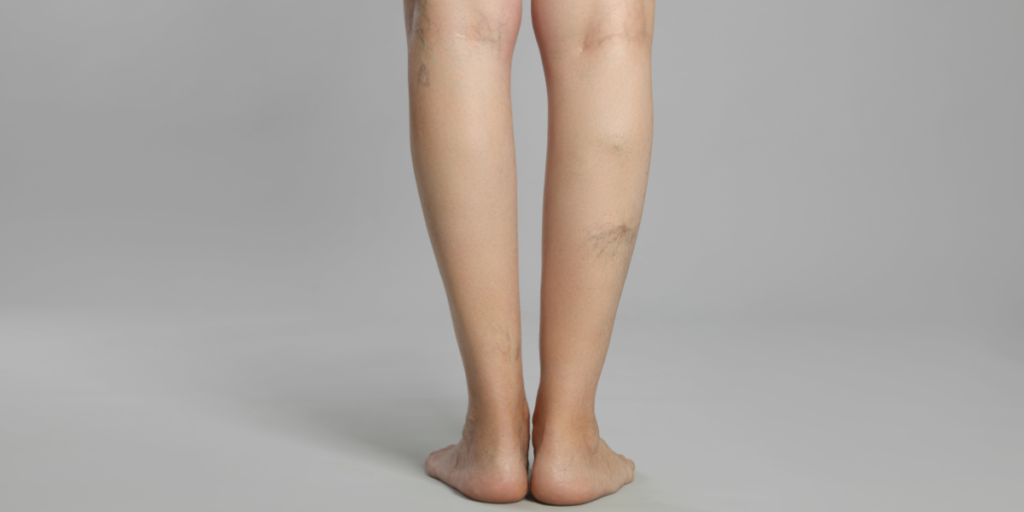 Causes and Prevention for Varicose Veins Causes and Prevention for Varicose Veins