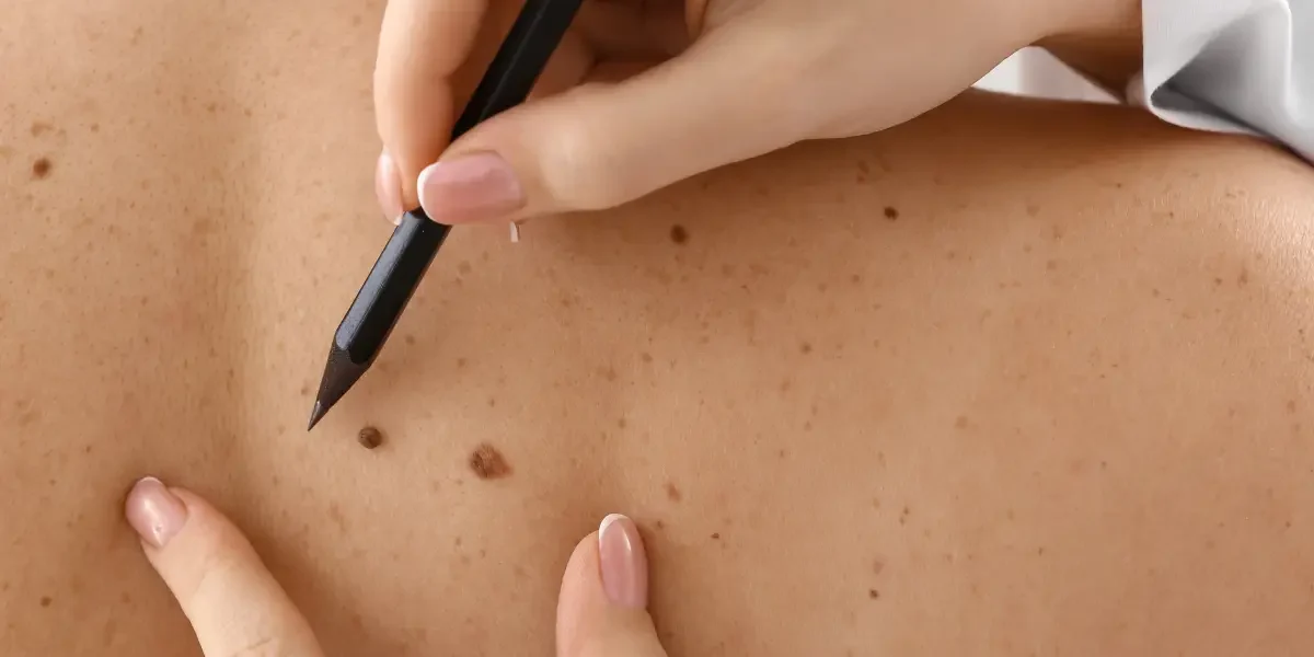How Dermatologists Use Technology in Skin Cancer Detection The Benefit of Education in Preventing Skin Cancer