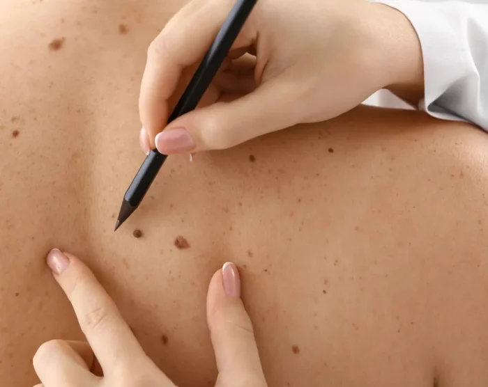 The Benefit of Education in Preventing Skin Cancer