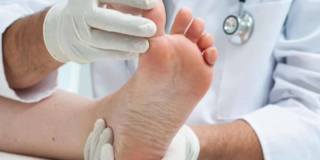 Symptoms, Diagnosis, and Treatment Options for Flat Feet in Adults