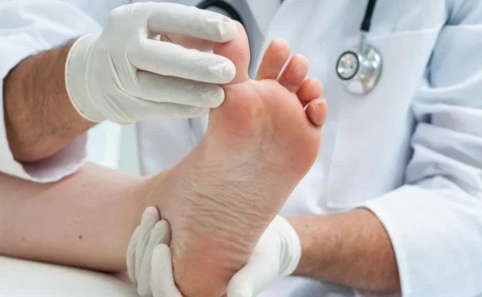 Symptoms, Diagnosis, and Treatment Options for Flat Feet in Adults Symptoms, Diagnosis, and Treatment Options for Flat Feet in Adults