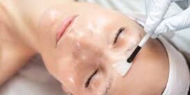 The Benefits of Chemical Peels for a Healthy Complexion