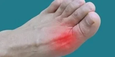 Understanding the Different Types of Gout and Their Symptoms