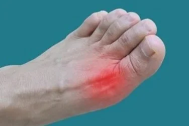 Understanding the Different Types of Gout and Their Symptoms