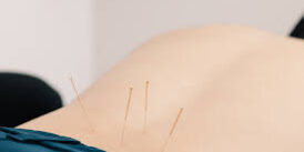 What To Know Before Visiting an Acupuncturist What To Know Before Visiting an Acupuncturist