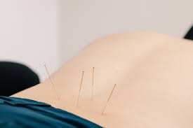 What To Know Before Visiting an Acupuncturist