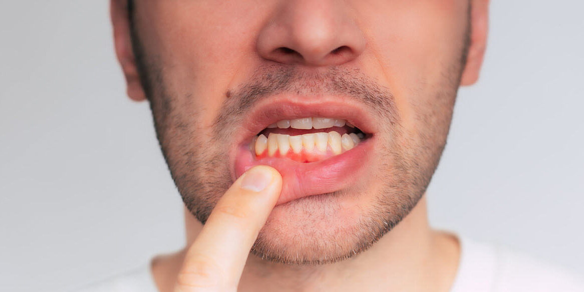 What are the Symptoms of Gum Disease What are the Symptoms of Gum Disease