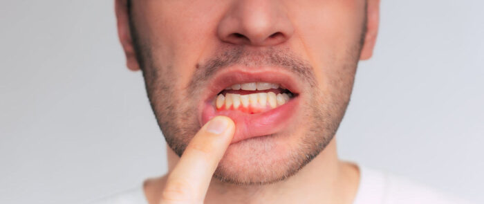 What are the Symptoms of Gum Disease What are the Symptoms of Gum Disease