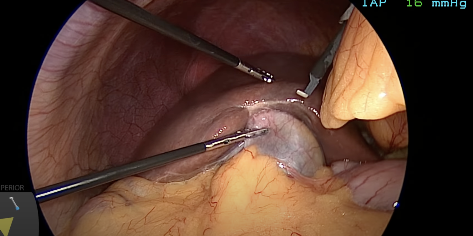 Exploring the Benefits of Gallbladder Removal