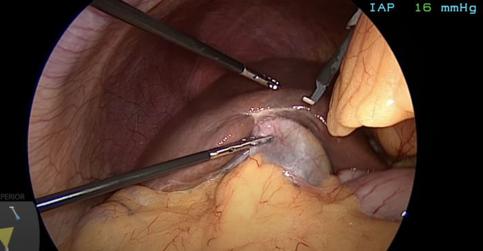Exploring the Benefits of Gallbladder Removal