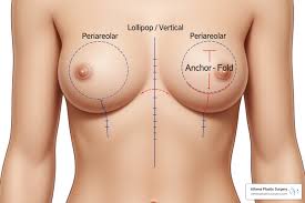 Exploring the Different Types of Breast Surgery Options