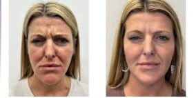 How Botox Can Refresh Your Appearance How Botox Can Refresh Your Appearance