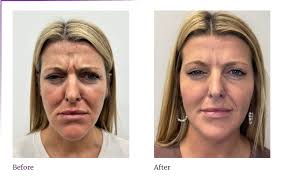How Botox Can Refresh Your Appearance