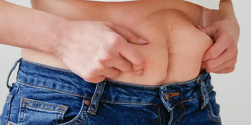 How Excess Skin Removal Surgery Can Transform Your Body Post-Bariatric How Excess Skin Removal Surgery Can Transform Your Body Post-Bariatric