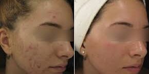 How Microneedling Helps Acne Scars How Microneedling Helps Acne Scars