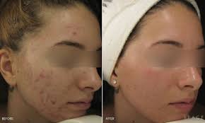 How Microneedling Helps Acne Scars