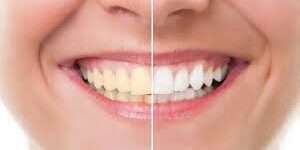 How to Choose the Right Teeth Whitening Option for Your Smile