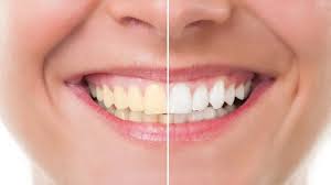 How to Choose the Right Teeth Whitening Option for Your Smile