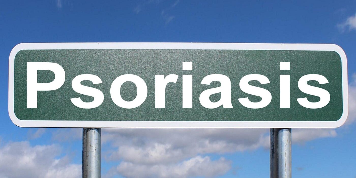 Innovative Therapies for Psoriasis Innovative Therapies for Psoriasis