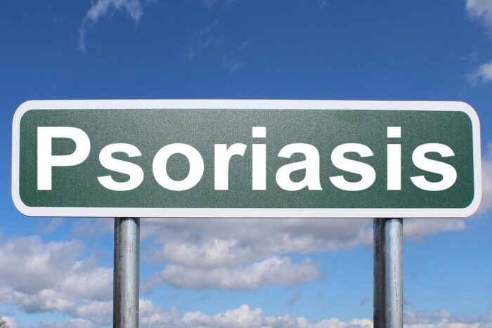 Innovative Therapies for Psoriasis