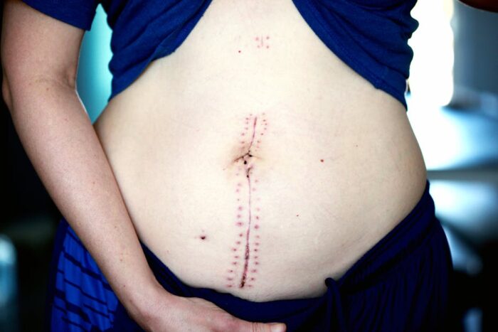 The Benefits of a Tummy Tuck for Post-Pregnancy Bodies