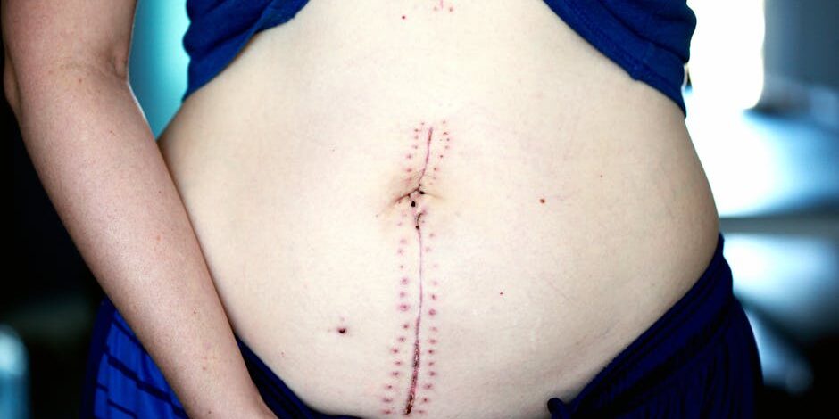 The Benefits of a Tummy Tuck for Post-Pregnancy Bodies
