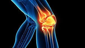 Understanding the Connection Between Joint Pain and Arthritis