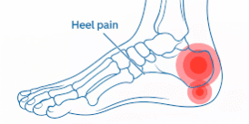 Understanding the Different Types of Heel Pain and Their Causes