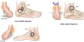 Understanding the Symptoms of Sprained Ankles Understanding the Symptoms of Sprained Ankles