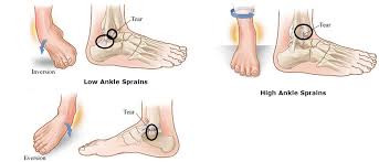 Understanding the Symptoms of Sprained Ankles