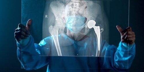 Right,Femoral,Neck,Fracture.,X-ray,Photo,Of,Man.,Roentgenogram.,Next When To Look at Hip Replacement Surgery