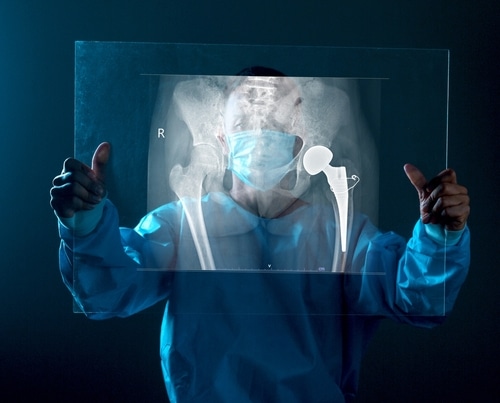 When To Look at Hip Replacement Surgery