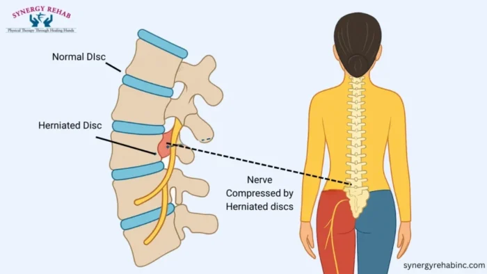 Benefits of Getting Quick Treatment for a Herniated Disc