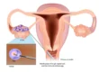 Understanding How Egg Freezing Works During IVF