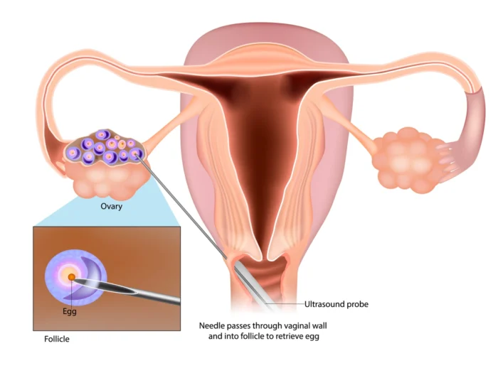 Understanding How Egg Freezing Works During IVF Understanding How Egg Freezing Works During IVF