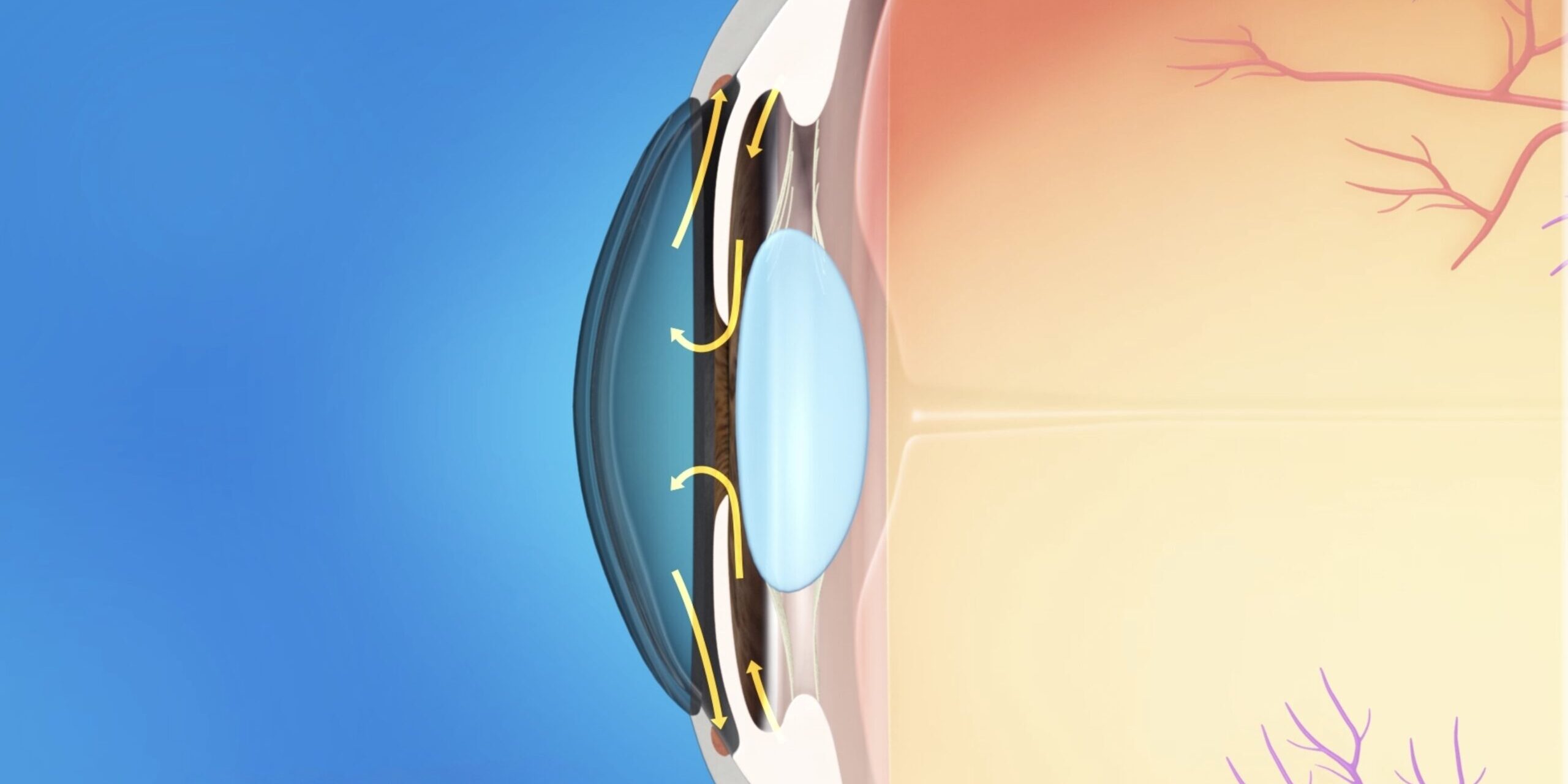 What To Do After a Glaucoma Diagnosis