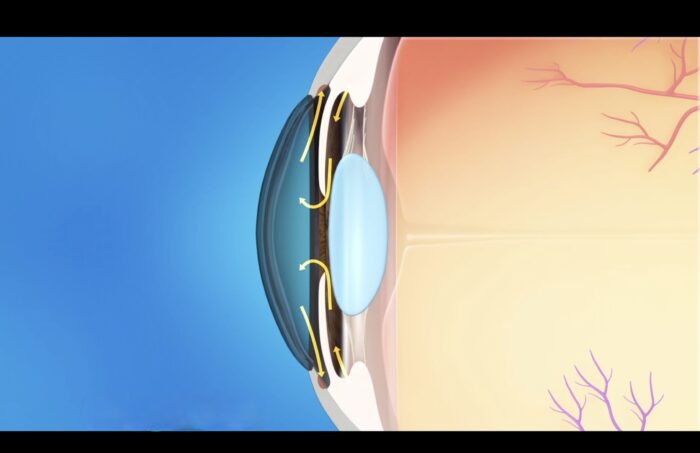 What To Do After a Glaucoma Diagnosis