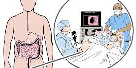 What To Expect When Getting Colon Surgery What To Expect When Getting Colon Surgery
