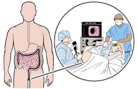 What To Expect When Getting Colon Surgery