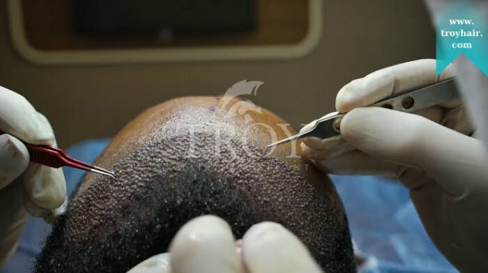 What to Expect During a Hair Restoration Procedure