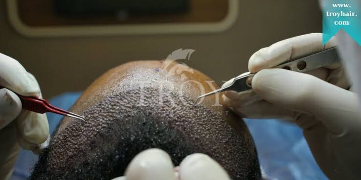 What to Expect During a Hair Restoration Procedure What to Expect During a Hair Restoration Procedure