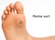 Common Types of Warts and Their Treatments