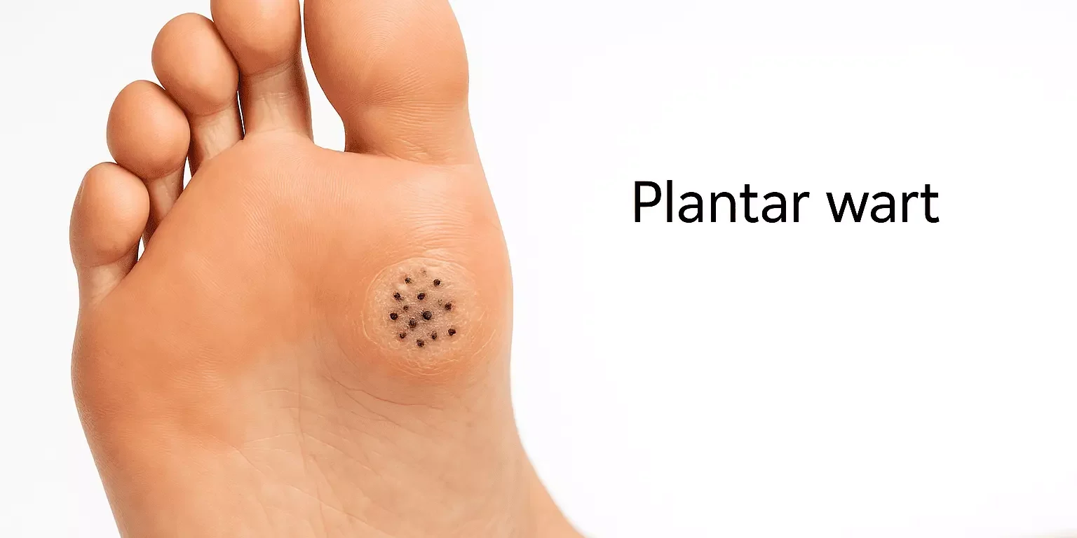 Common Types of Warts and Their Treatments Common Types of Warts and Their Treatments