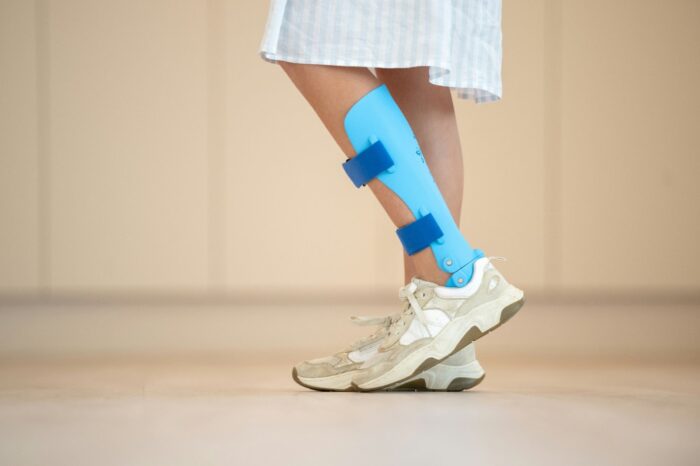 How To Prepare for Ankle Replacement