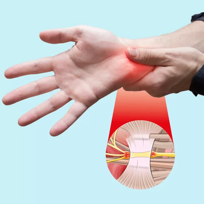 Identifying the Signs and Symptoms of Carpal Tunnel Syndrome Identifying the Signs and Symptoms of Carpal Tunnel Syndrome